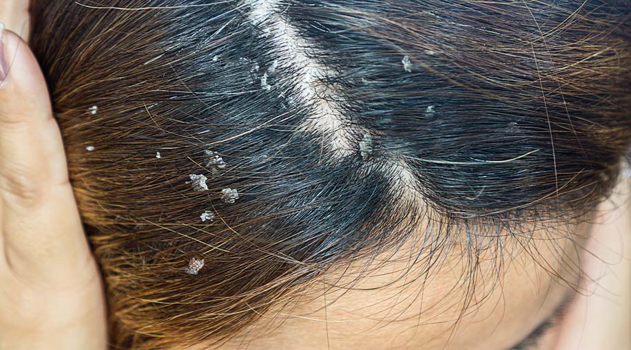 Dry skin in someone's hair on their scalp.