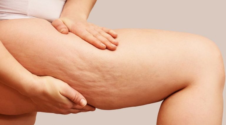 A woman holding her upper leg, showing cellulite.